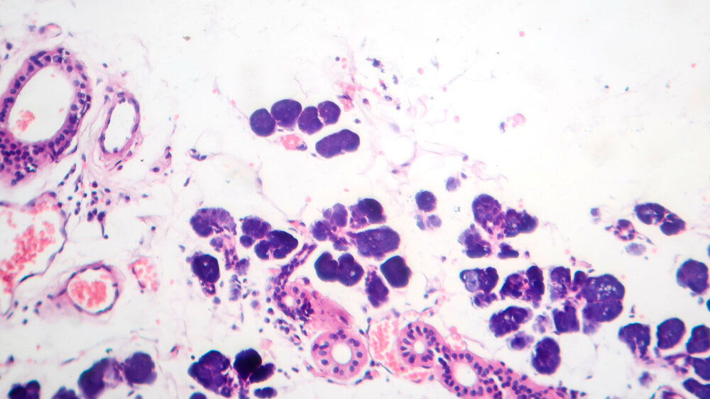 Mixed parotid tumor, photomicrograph showing epithelial and myoepithelial cell components within chondromyxoid stroma, typical of pleomorphic adenoma.
