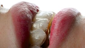 Symbolbild Frau trägt Aligner Closeup