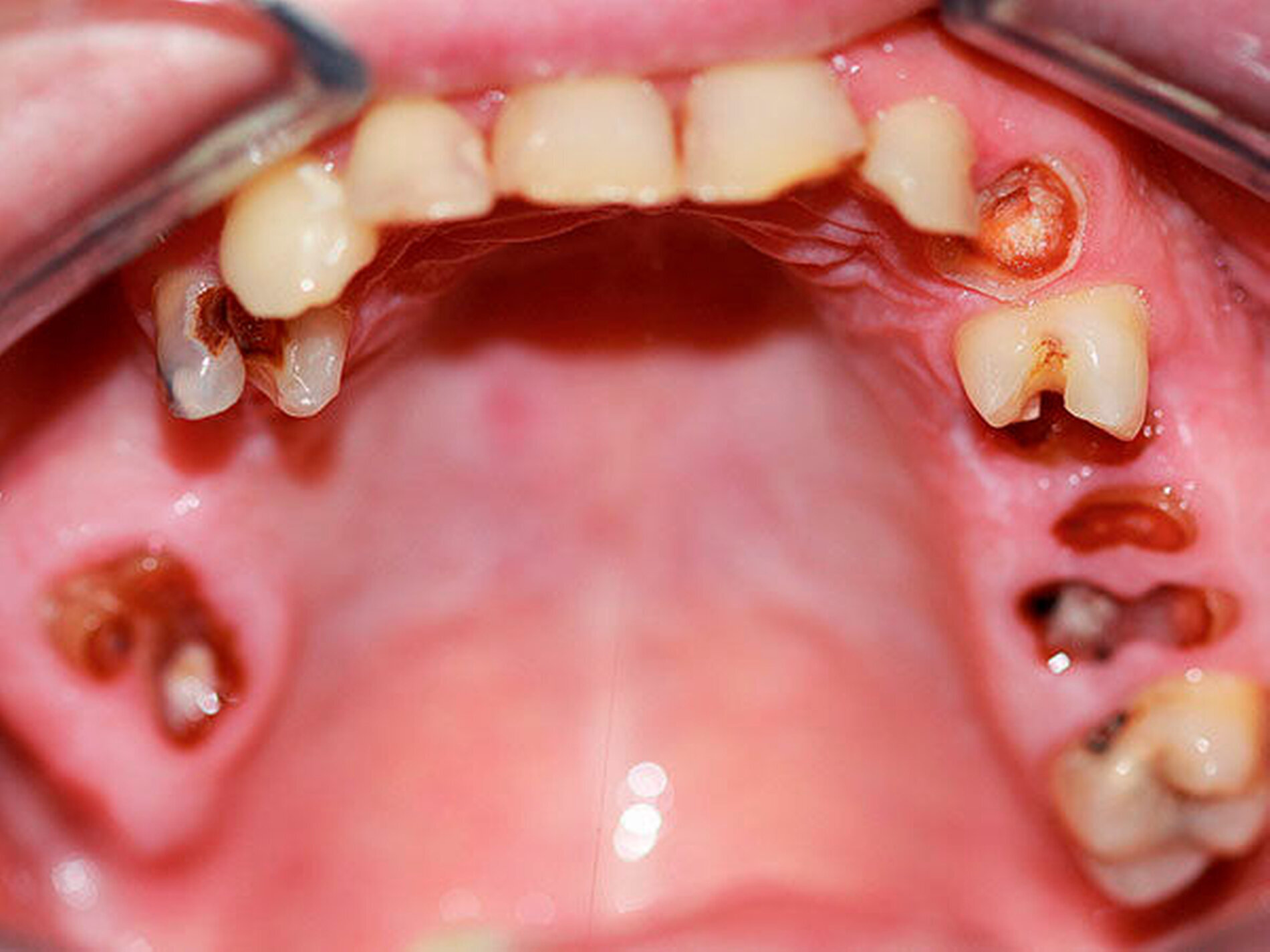 Der „Meth mouth“: Symptomatik, Diagnostik, Therapie - zm-online