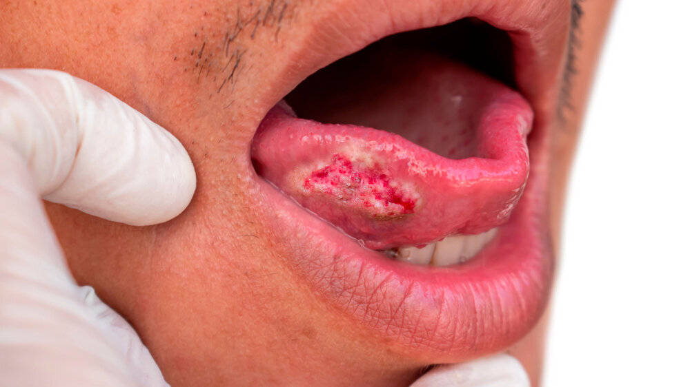 Squamous cell carcinoma of tongue. Oral cancer or malignant tumor. Plattenepithelkarzinom der Zunge. Mundkrebs oder bösartiger Tumor.