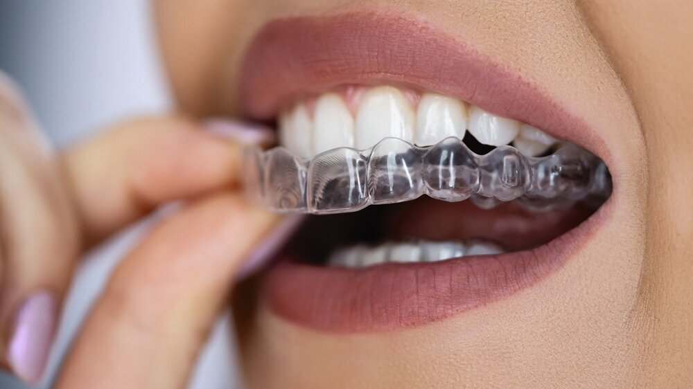 Clear Aligner Dental Night Guard Aligner