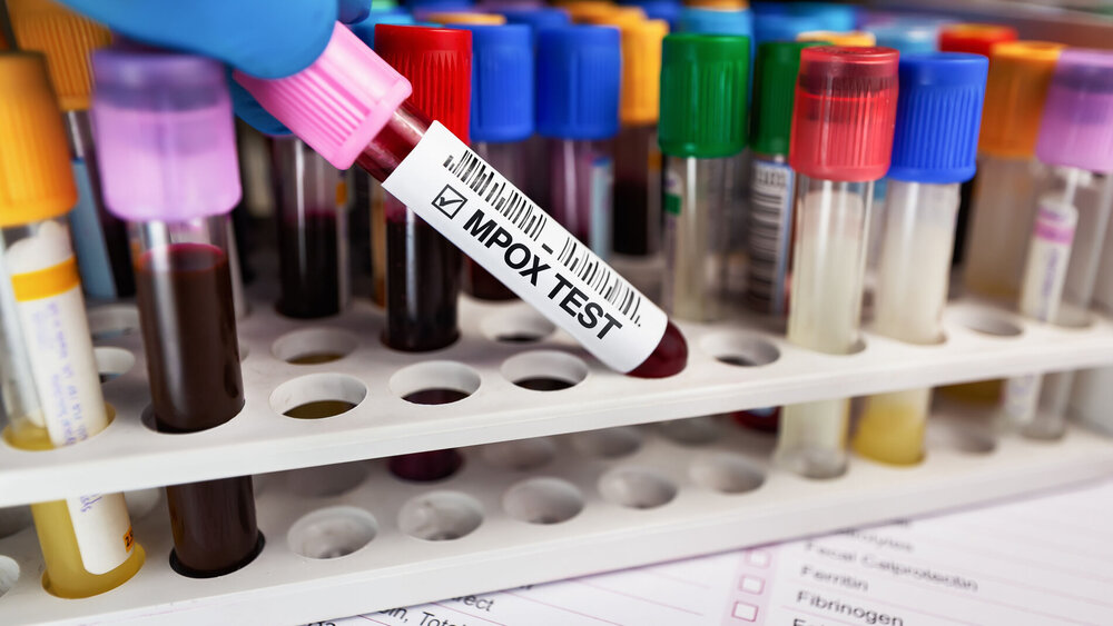 MpoX-Test im Labor: Blutröhrchen mit Scann Code Etikett.