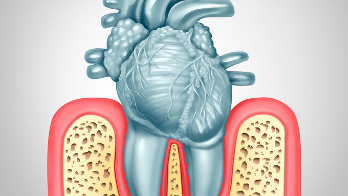Dental Care Heart Disease Parodontitis und Herzerkrankungen
