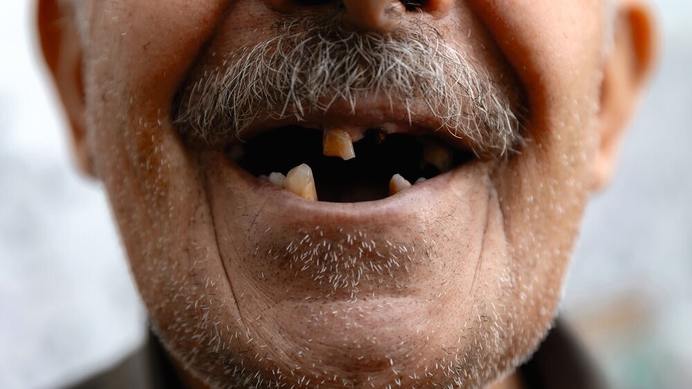 Old man without part of his teeth is smiling zahnverlust