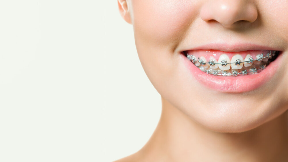 Close-up portrait of young cheerful readhead woman in summer wear makes selfie on smartphone, over pink background Orthodontic Treatment. Dental Care Concept. Beautiful Woman Healthy Smile close up. Closeup Ceramic and Metal Brackets on Teeth. Beautiful Female Smile with Braces