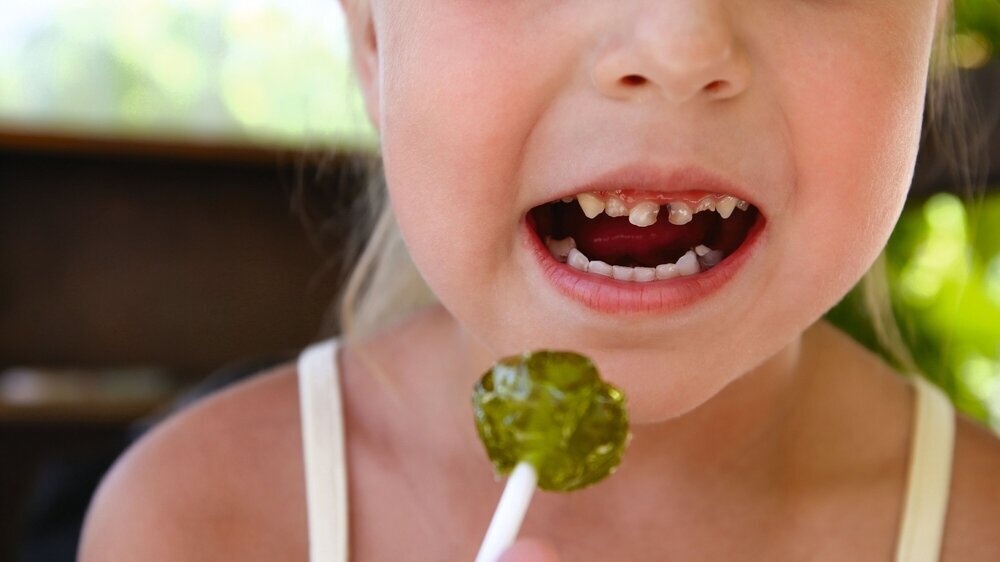 Child eats candy. Girl has caries on teeth. Mädchen mit Lolli und Karies