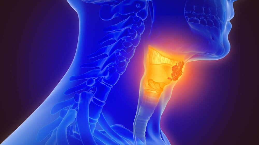 3d illustration of throat cancer Mundrachenkrebs Oropharynxkarzinom