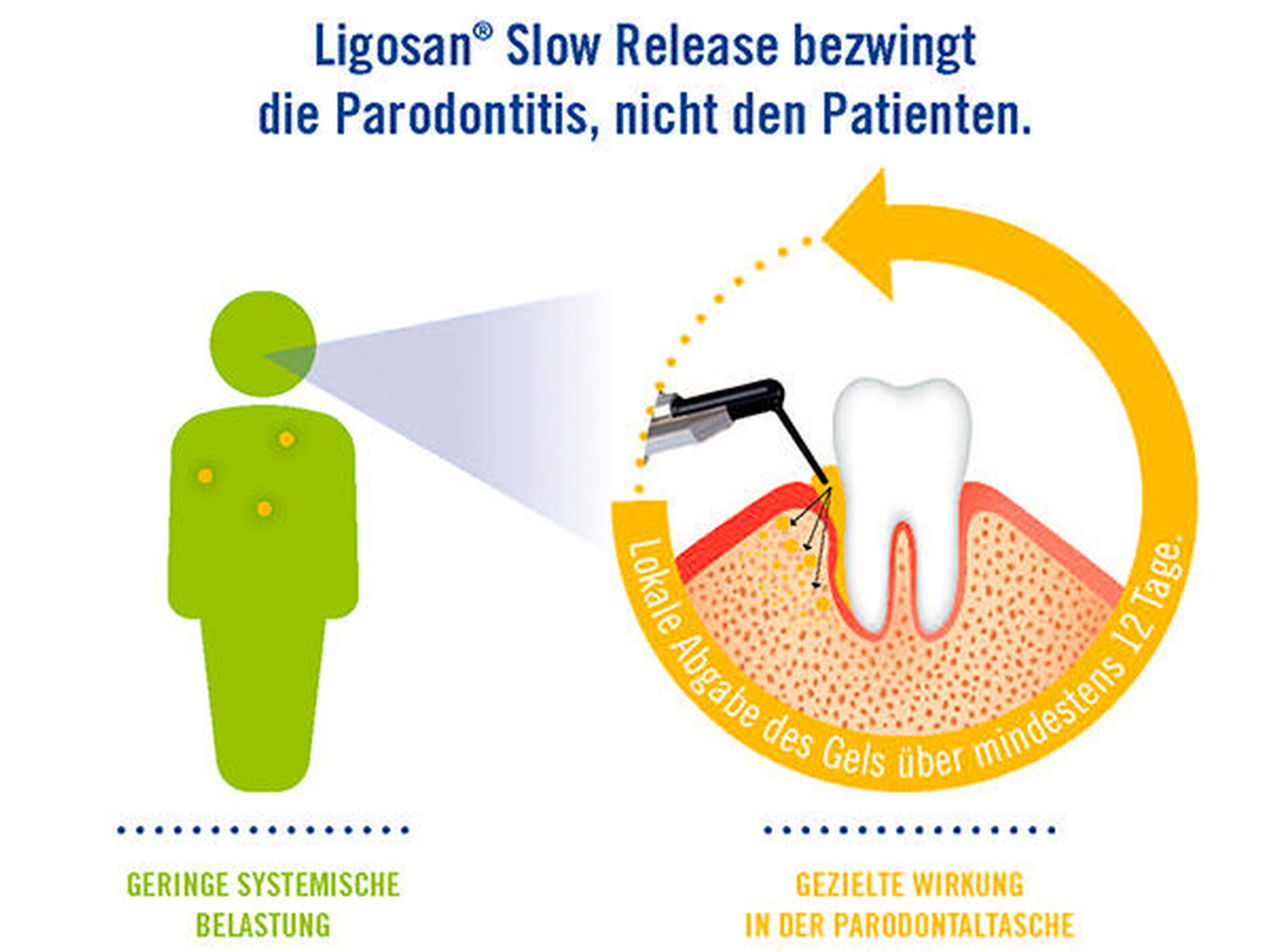 Parodontitistherapie Lokal Und Ohne Systemische Belastung - Zm-online