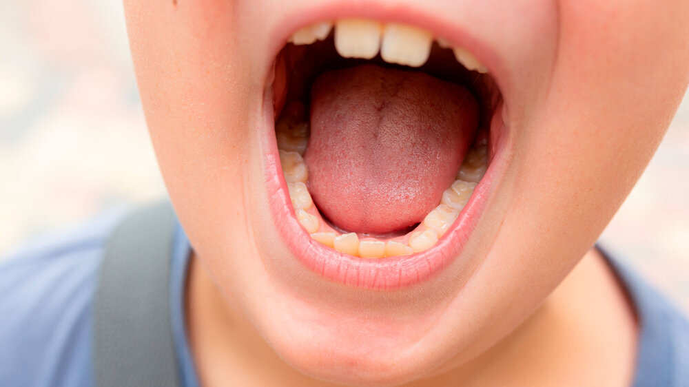 Close-up of a boy showing a fallen tooth. Loss of teeth, concept of dental problems Kinderzähne