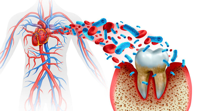 Tooth Decay Disease Parodontitis und Herzerkrankungen