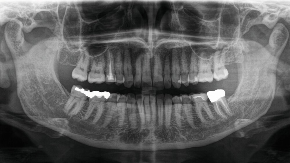 Orthopantomogramm der Patientin ohne erkennbare pathologische Befunde im Bereich des Canalis mandibularis rechts.